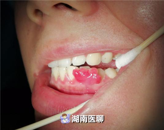 原创科普牙龈有问题孕期莫忽视,孕期牙龈上长了个小肉疙瘩图片