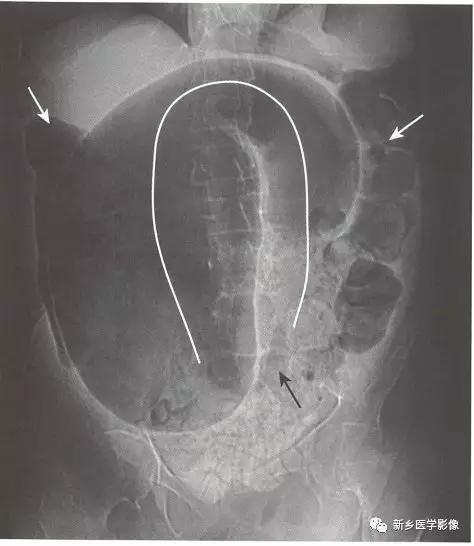 辨识肠梗阻,肠梗阻死亡前兆