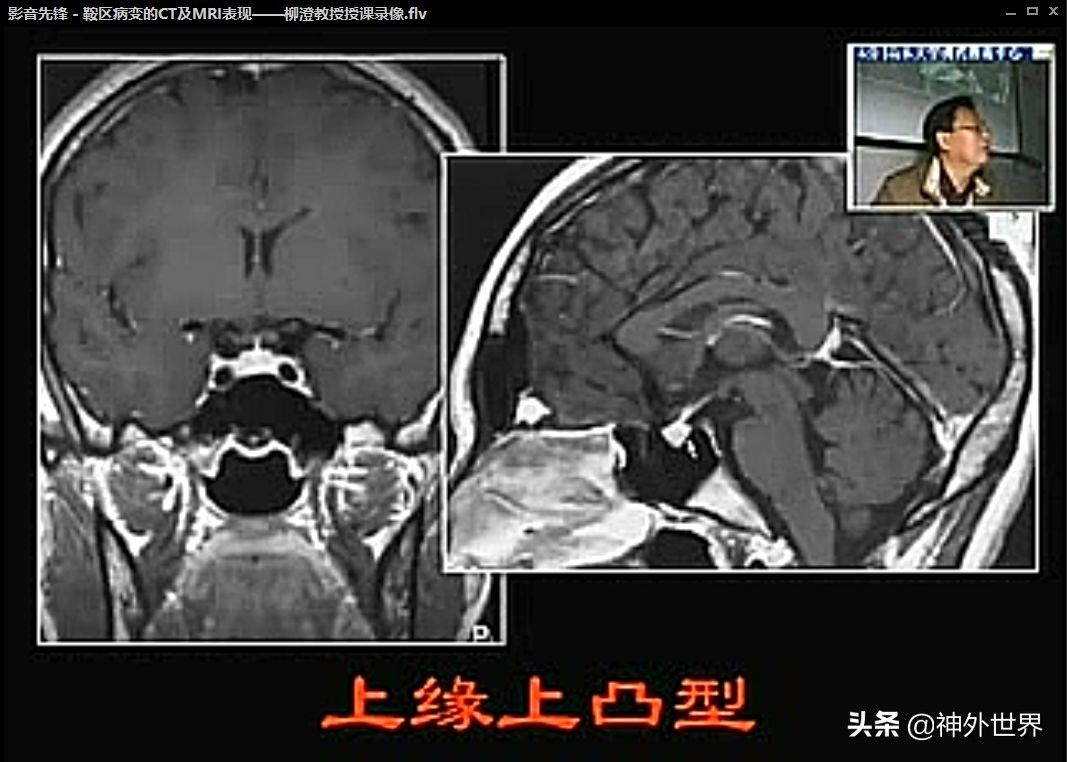 鞍区解剖学习笔记之——垂体