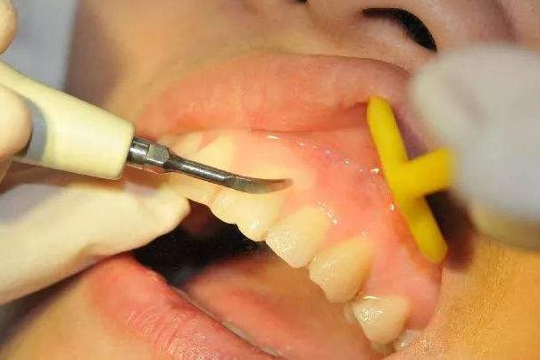 如何去除牙齿上的黑渍,如何去除牙齿上的黑渍用小苏打