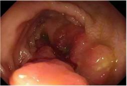 肠穿孔非手术治疗措施,结肠穿孔治疗视频