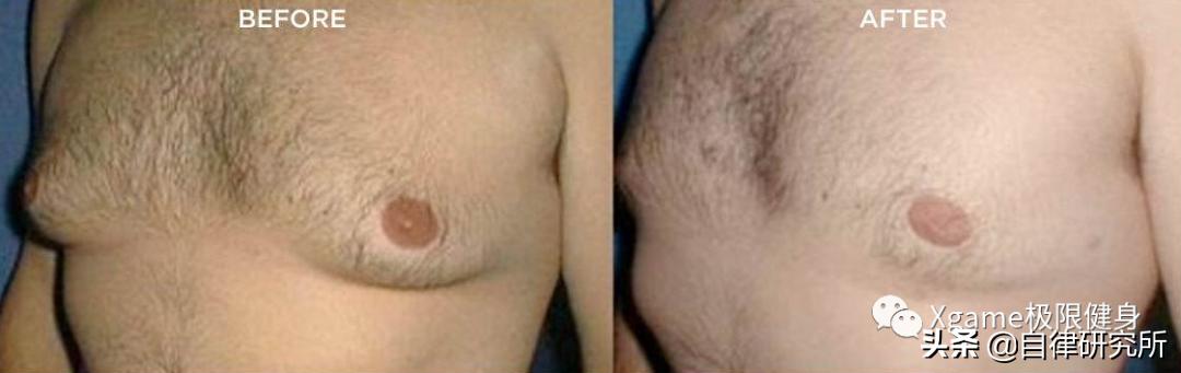 男性雌化胸的最佳治疗方法,男士雌化胸怎么改善