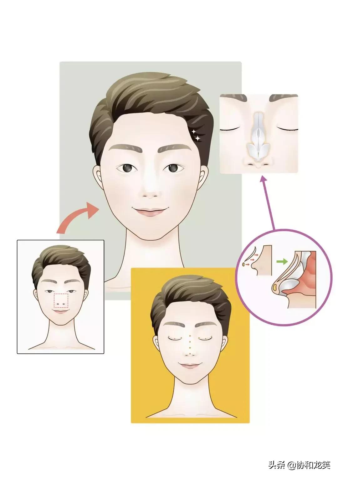 什么是假体隆鼻术,什么是微创隆鼻术