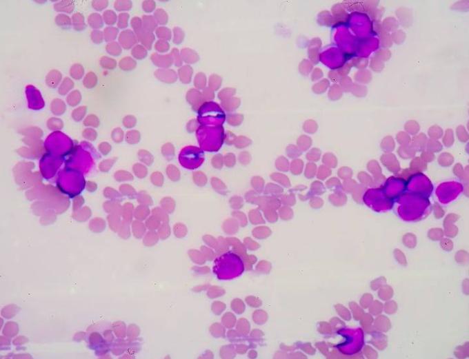 为何确诊肺炎，但白细胞却并不高？赶紧来了解一下