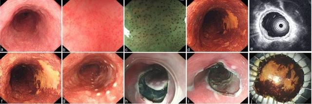 食管癌诊疗规范（2018年版）