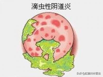 疫情期间妇科怎么做,疫情期间女性盆腔炎