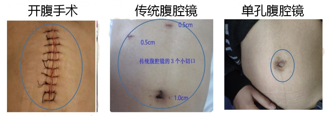 黔南州中医医院单孔腹腔镜为女性患者带来新福音