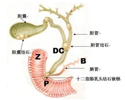 安徽中西医结合医院治疗结石,北京中医谁能治胆结石