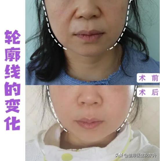 去除法令纹什么手术最好,微创祛除法令纹怎么做