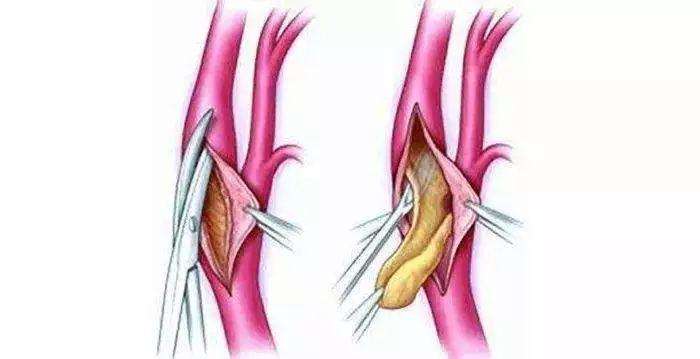 颈部血管有斑块需要怎么处理,颈部血管有斑块可以怎么治疗