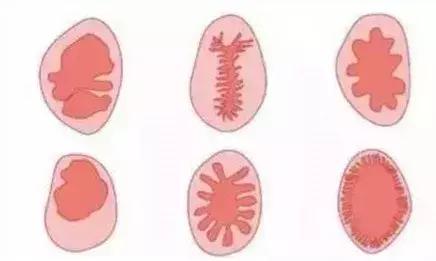 同房后出血莫忽视,有可能是恶性肿瘤信号