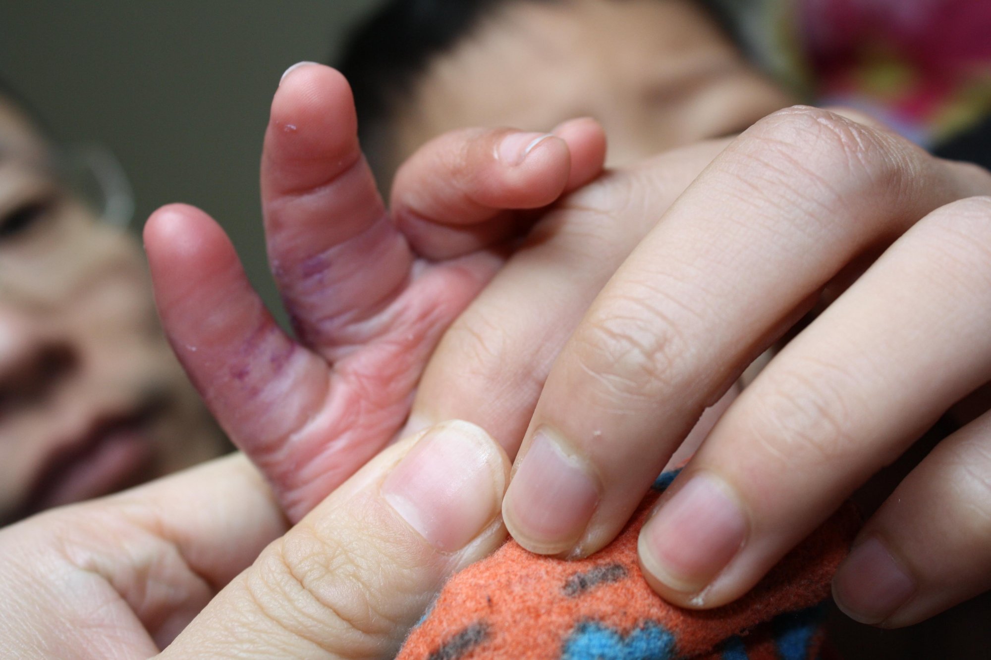 孩子被烫伤紧急急救,小儿意外烫伤要如何急救