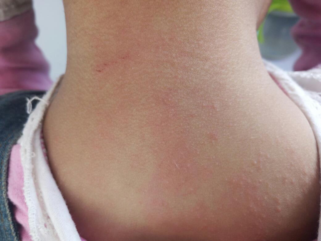 麦粒肿眼睛内部的症状图片,麦粒肿预兆图片