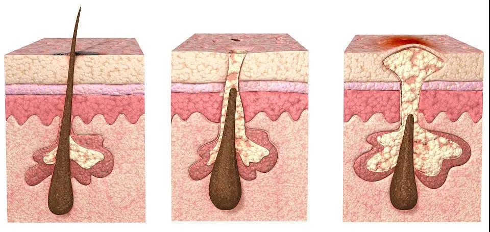 痘痘肌护理视频,痘痘肌必看如何护理痘肌