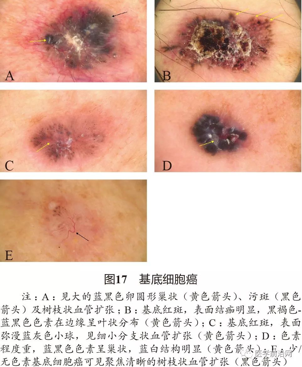 面部常见皮肤病皮肤镜诊断专家共识全文发布