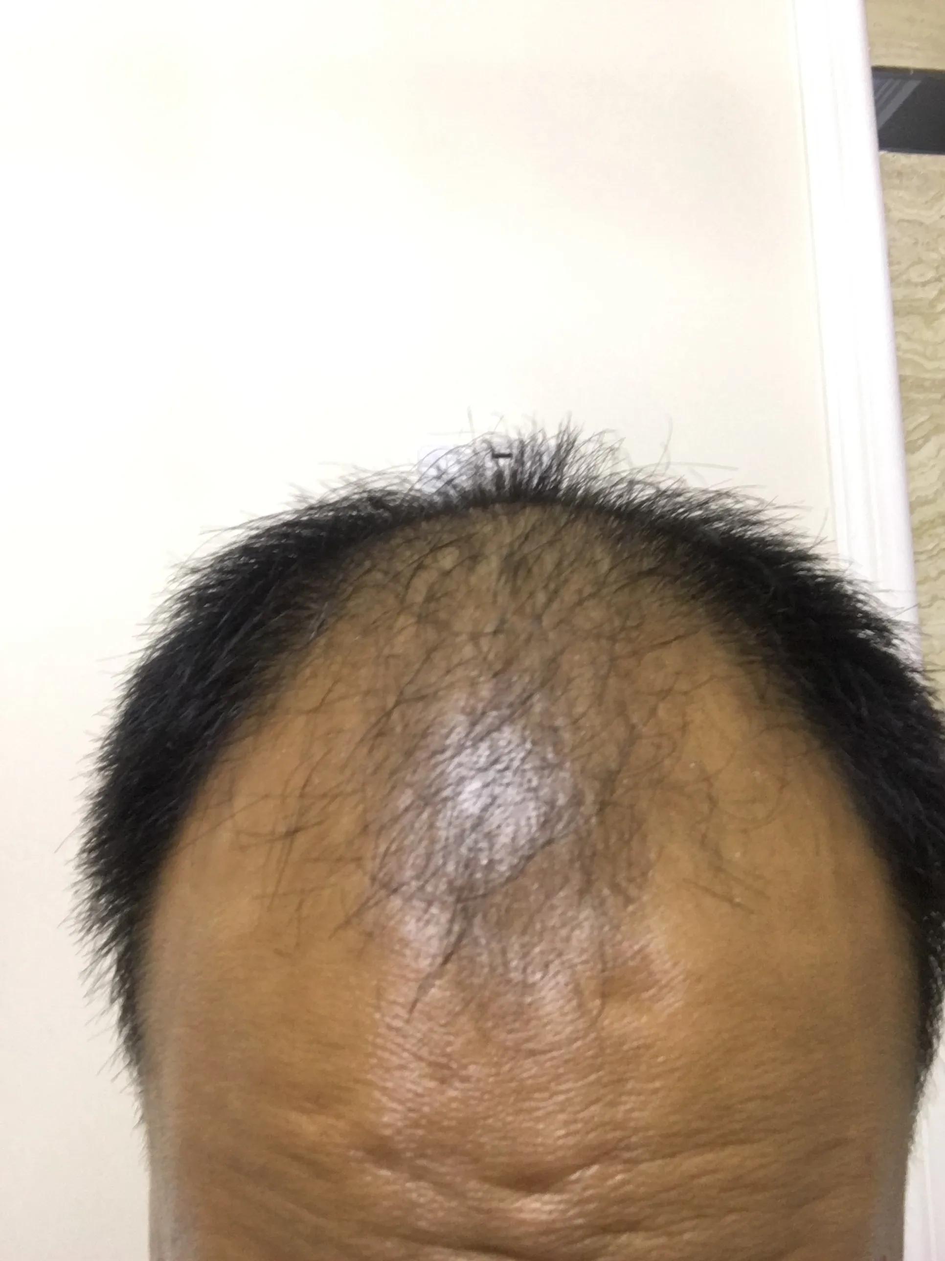 脂溢性脱发的治疗费用,脂溢性脱发的治疗方式