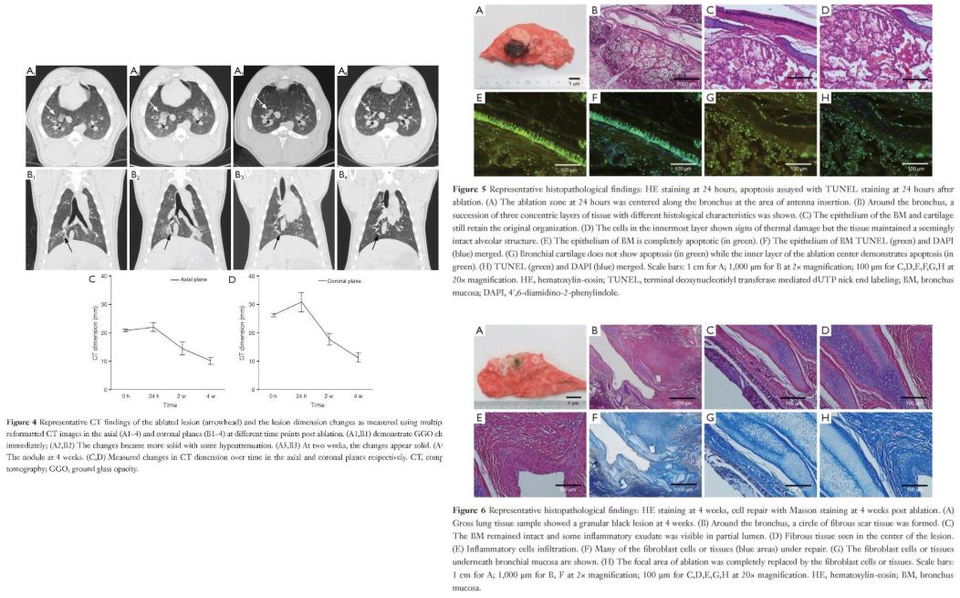 支气管镜高频电刀治疗中央型肺癌,支气管镜在早期肺癌诊断的意义