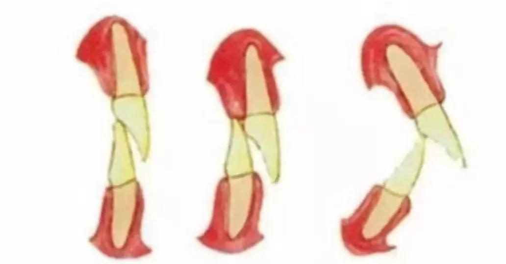 “龅牙”是深覆颌还是深覆盖,两者如何区分?