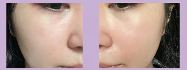 抗炎痘痘,痘痘肌抗炎产品