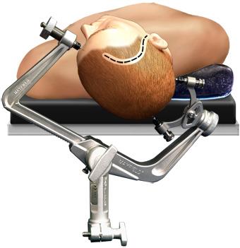 开颅手术的开颅是个什么样的操作,开颅手术最危险的是什么样情况