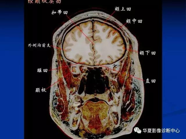 mra头颅解剖学详细讲解视频,常见的头颅mri图像