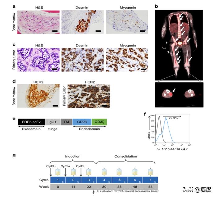7岁横纹肌肉瘤患儿康复，CAR-T细胞疗法这么神奇吗？