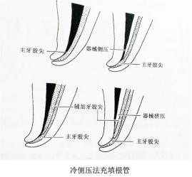 根管充填材料sp和bp的区别,牙科根管充填有什么好的充填材料