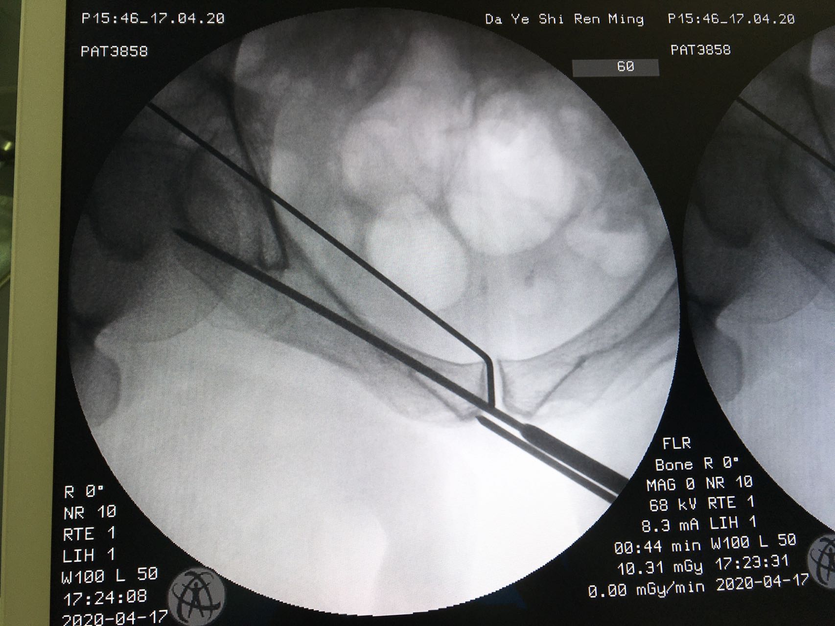 一名骨科医生股骨骨折经历,骨科朱医生