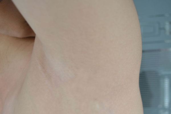 腋毛剃了多久长出,医院剃腋毛多少钱