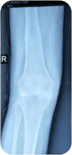 小针刀帮大忙，畸形3年伸不直的膝盖终有治