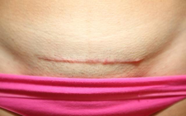 剖腹产产妇疤痕怎样修复,剖腹产疤痕对产妇有影响吗