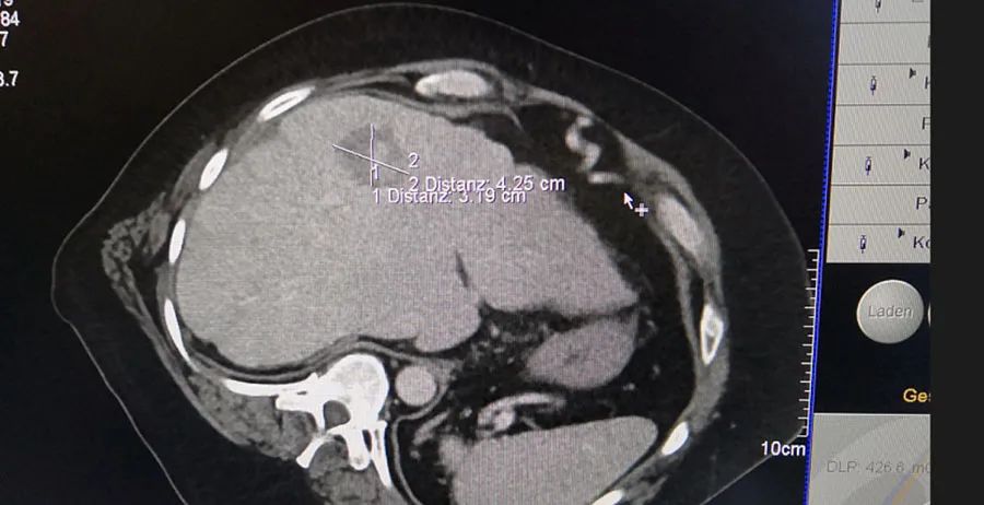国际化进程|赛诺微精准消融，走进精工德国