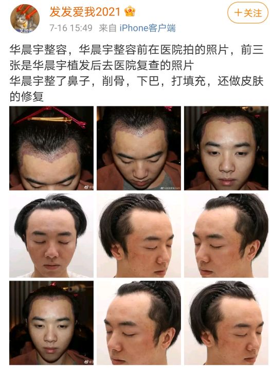 华晨宇植发成功了吗,华晨宇植发图片是真的吗
