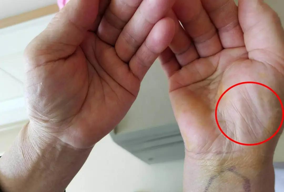 女子手指发麻是怎么回事,女子手麻是什么原因