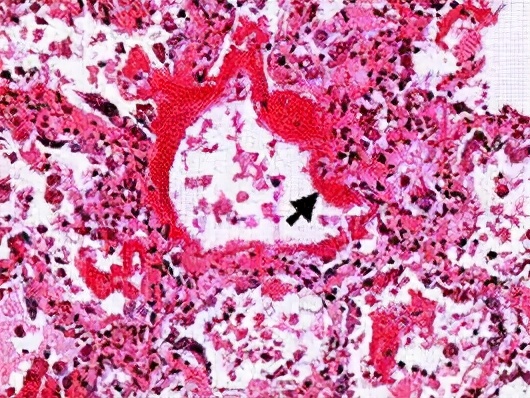 高镁血症的治疗方法 (高镁血症有哪些表现及如何诊断)