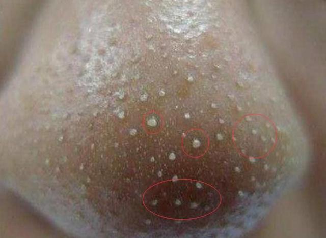 鼻子上挤出来的黄东西是什么,鼻子上挤出的黄色物体