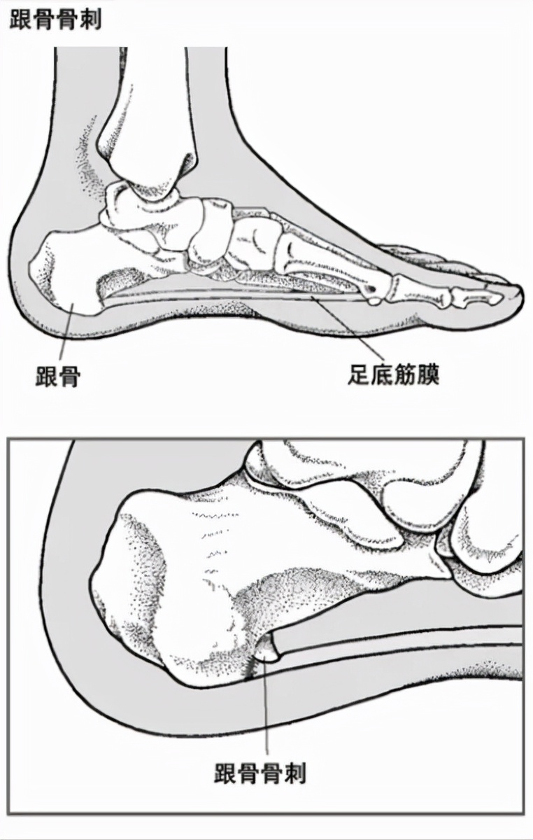 跟骨骨折和足跟骨刺哪个严重,足跟骨刺走路疼痛该如何治疗