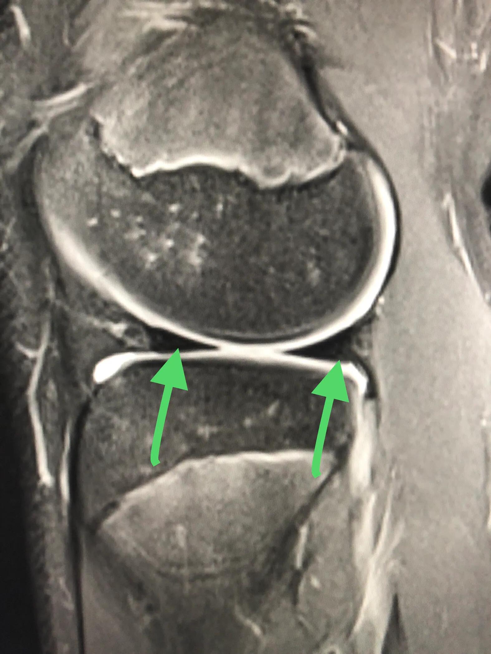 小构件大问题的膝关节半月板