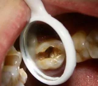 为什么牙疼起来真要命,牙疼不是病疼起来真要命