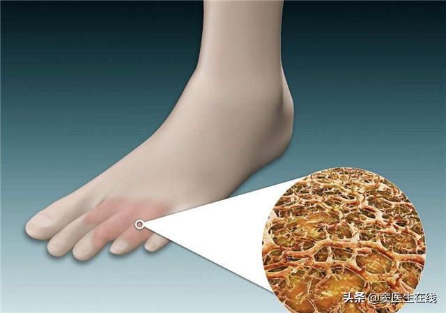 “脚气”真菌怎么治才能根除？2个简单小方法，彻底治好不复发