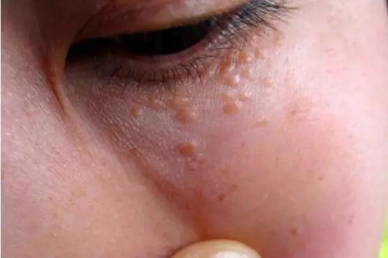 维生素e能除眼周的脂肪粒吗,消除眼周脂肪粒最好方法