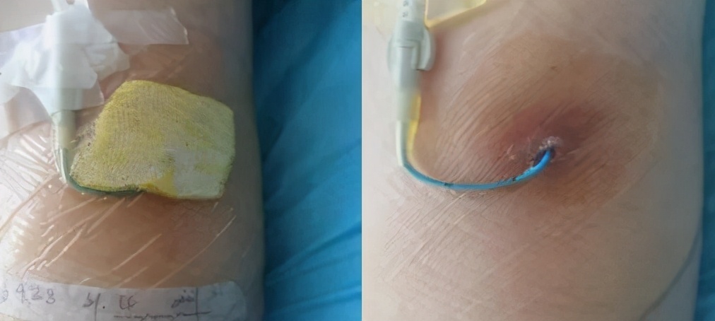 碘伏治疗伤口吗,碘伏治疗伤口发炎吗