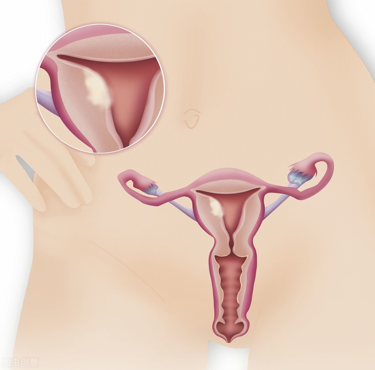 子宫肌瘤可以用中医治吗,治疗子宫肌瘤要避免误区