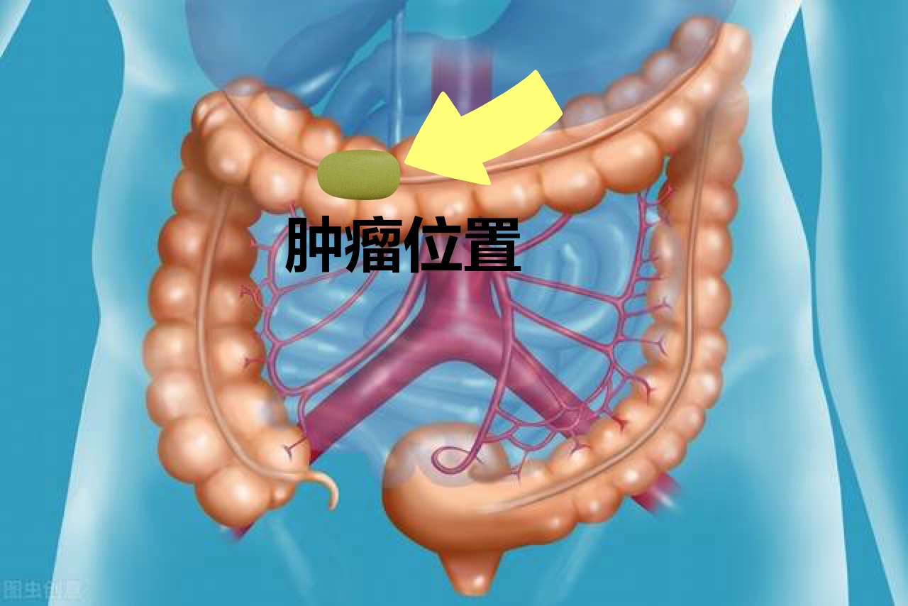 结肠癌患者会遗传直肠癌吗,结肠癌会遗传给子女吗