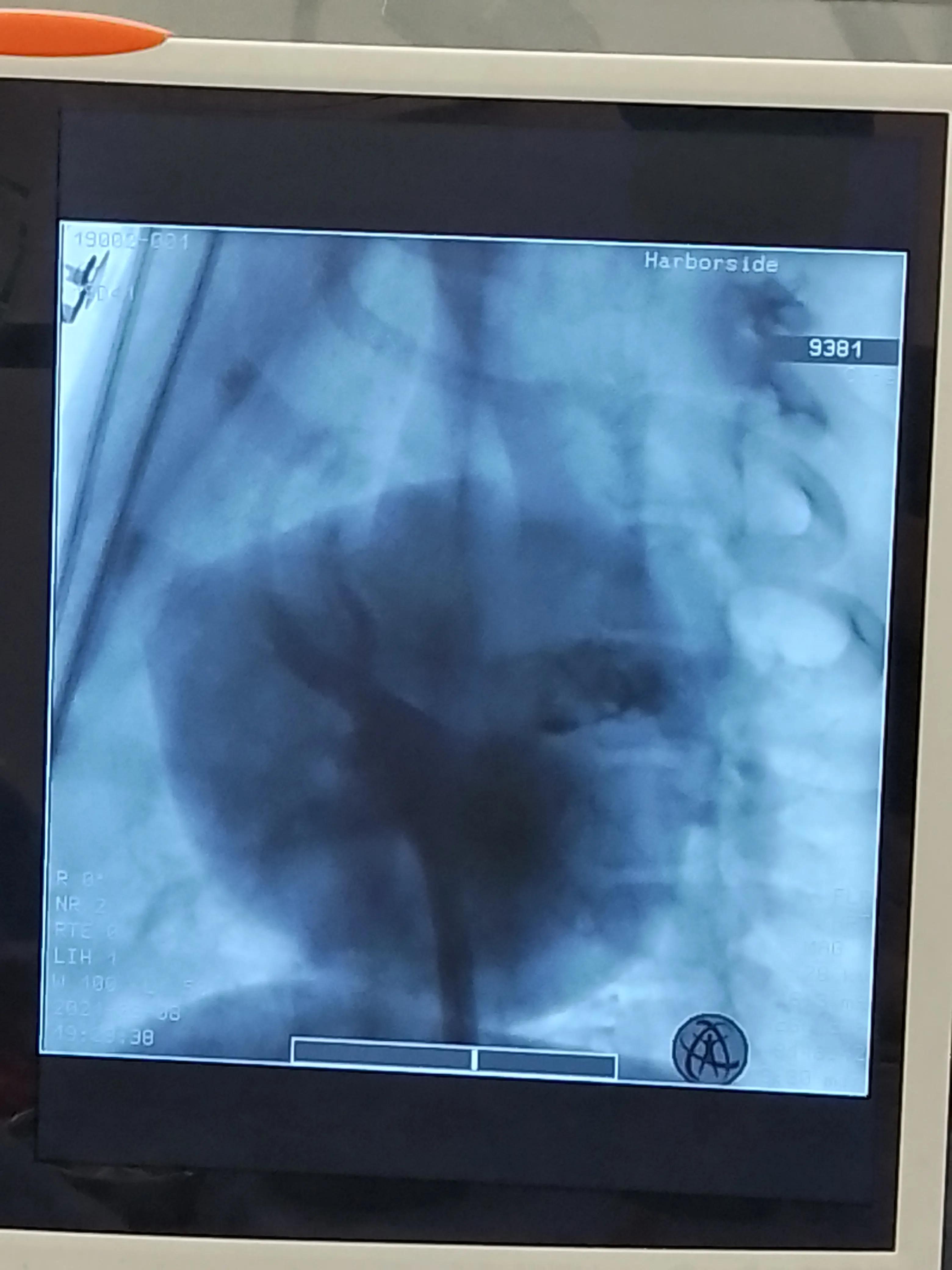 房颤射频消融术器械有哪些,脉冲消融治疗房颤品牌