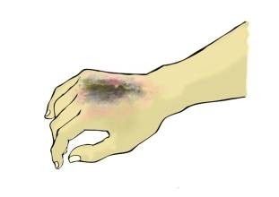 烧伤烫伤自救,烧伤后应急措施