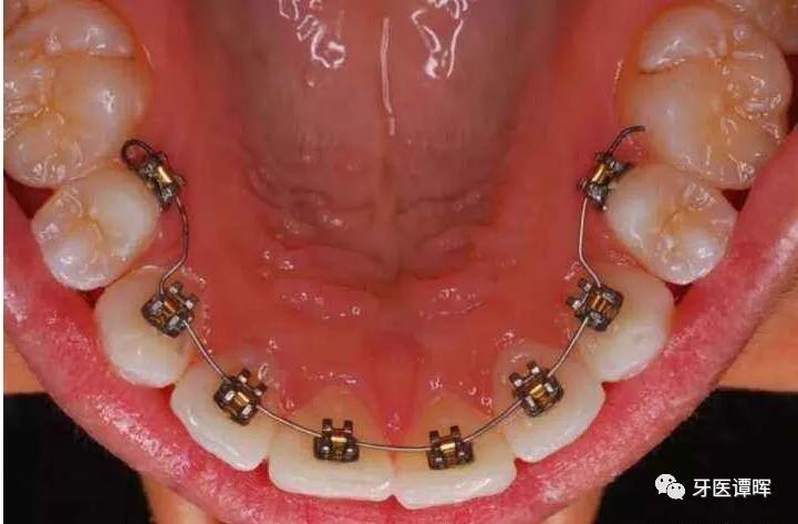 超详细的牙齿矫正过程,成人骨性牙齿矫正过程