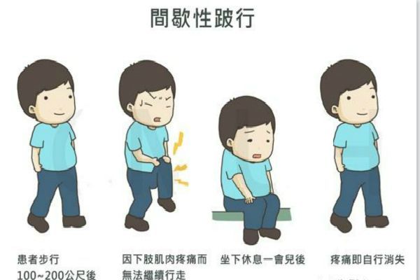 坐骨神经痛腿疼站立行走可以缓解,坐骨神经痛无法行走