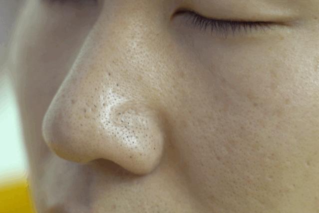 有黑头和没黑头有什么区别,没有长过黑头却长黑头怎么办