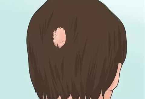 头皮脱了一层薄薄的皮,头皮脱一层皮怎么办